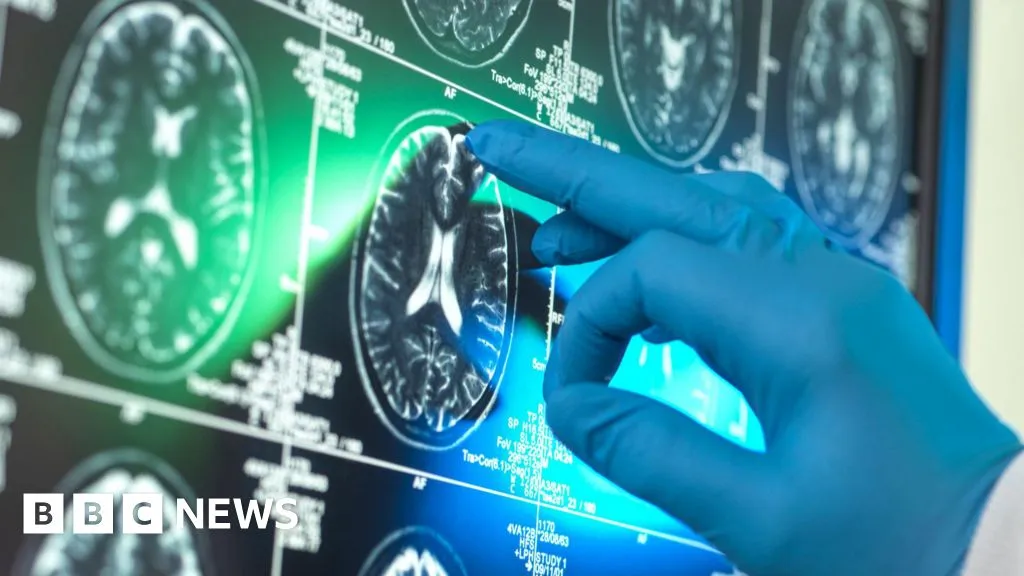 Report suggests 'breakthrough' Alzheimer's drugs unlikely to benefit patients