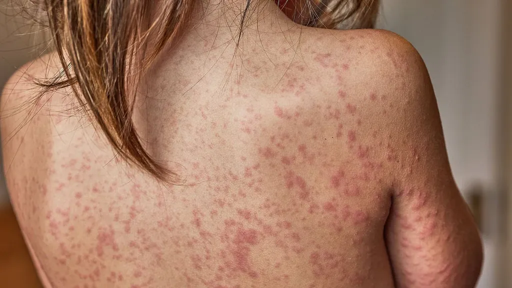 Fears London will be gripped by 'fast spreading measles outbreak'