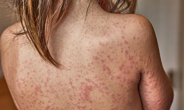 Schools 'looking to bar unvaccinated children' during measles outbreak