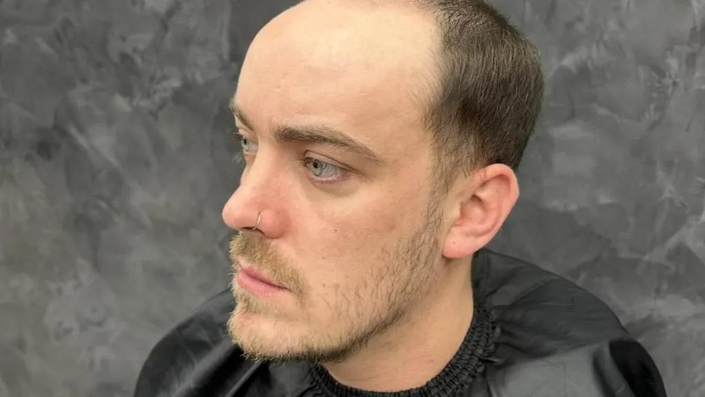 When I started balding I was so insecure, then I found a miracle