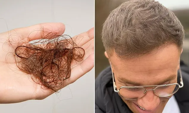 I started going bald at 25. Now I have REVERSED my hair loss