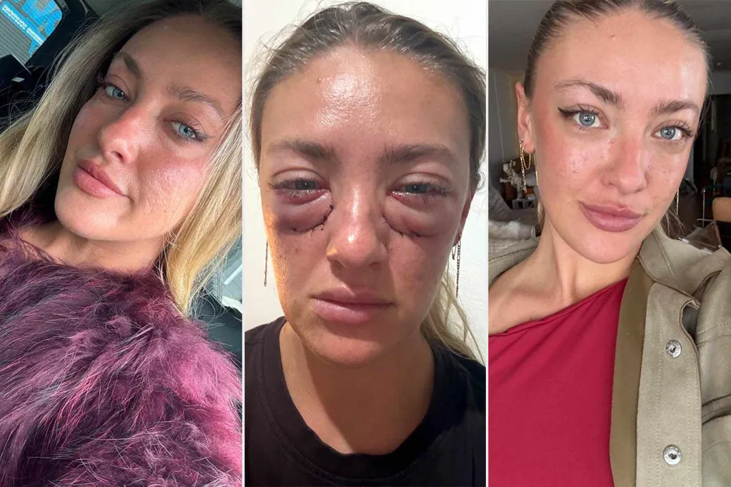 Woman Was in 'Shock' from the Results of Her Cosmetic Eyelid Surgery. Then She Was Called 'Botched' Online (Exclusive)
