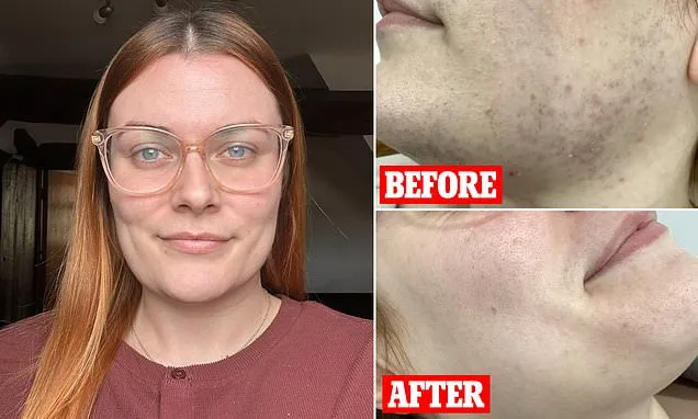 How to end the curse of female facial hair, with this new treatment