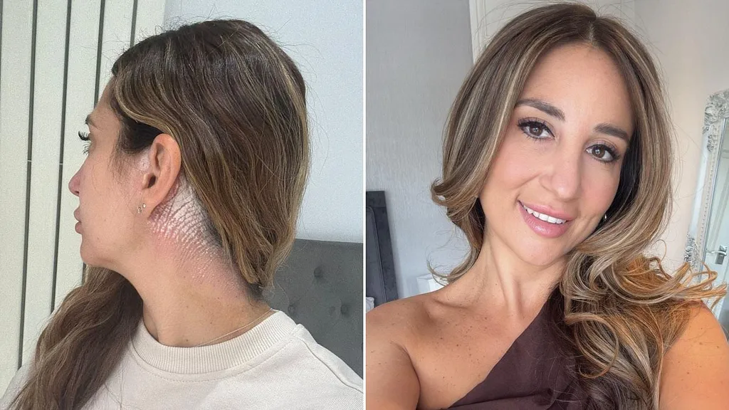 How a new treatment may finally help my painful scalp condition