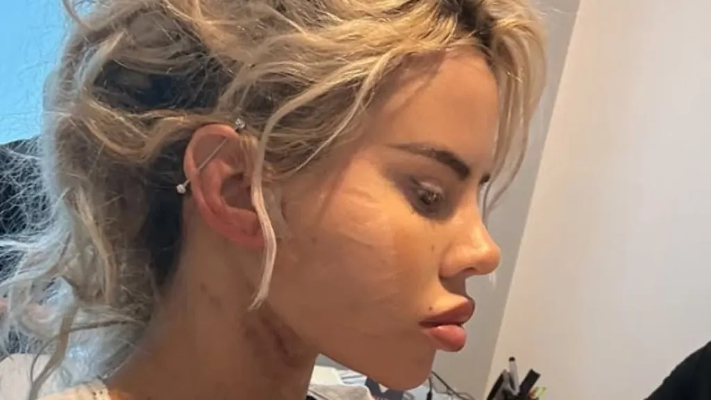 Hannah Elizabeth shows off the results of her facelift and neck lipo