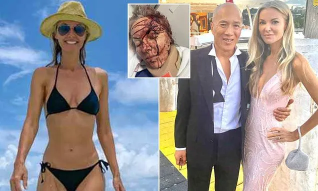 Charlie Teo's girlfriend speaks out after suffering horror injuries