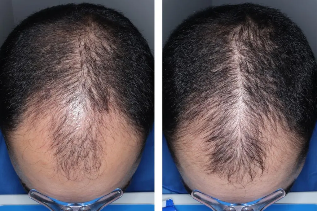 Experimental hair loss pill just cleared a major hurdle  --  when it could hit shelves