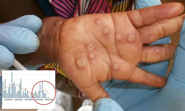 Most dangerous strain of mpox detected in major West Coast city