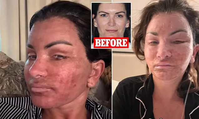 Woman shares brutally honest look into facelift recovery