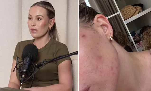 Kate Ferdinand says living in Dubai is giving her skin breakouts