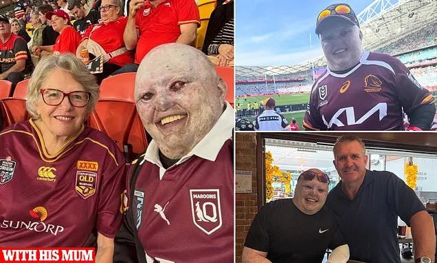 Man with skin condition slams trolls over footy visit with his mum