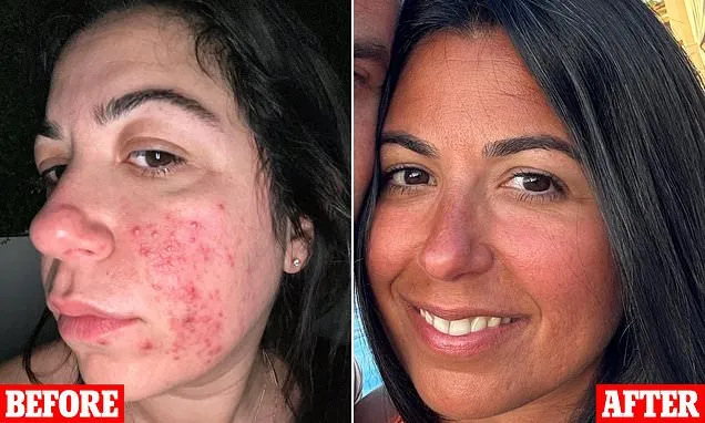 I tried everything for my acne but this is what cleared my skin