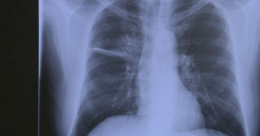 Colorado lung cancer doctor reveals his own diagnosis to help others