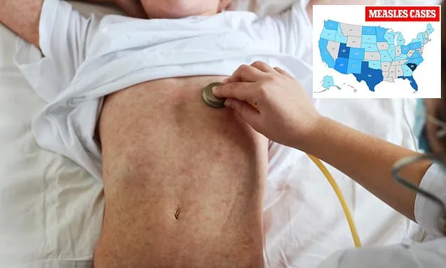 Multiple states battle measles outbreaks as virus resurges nationwide