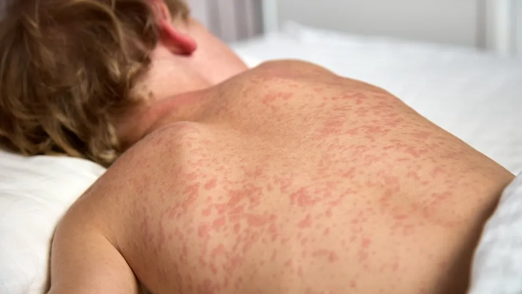 Urgent measles alert for millions of Aussies