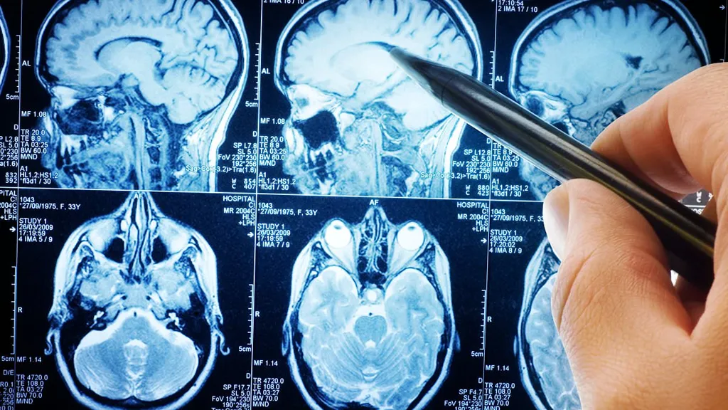 Trigger behind aggressive brain cancer uncovered