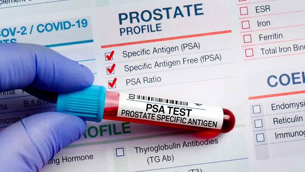 NHS advisors set to reject prostate screening programme for most men