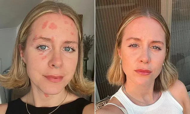 After countless treatments for my psoriasis THIS is what really works