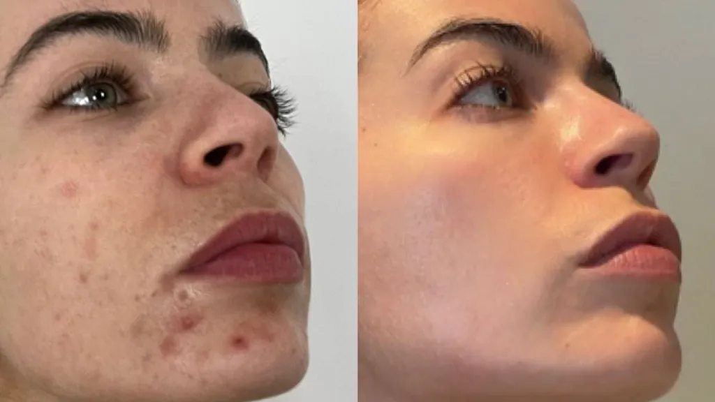 I've always been embarrassed by my spotty skin. This restored it