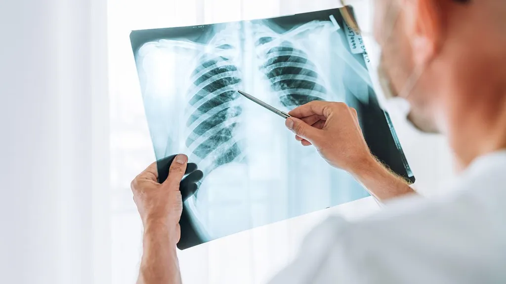 More people with lung cancer symptoms should self-refer for tests