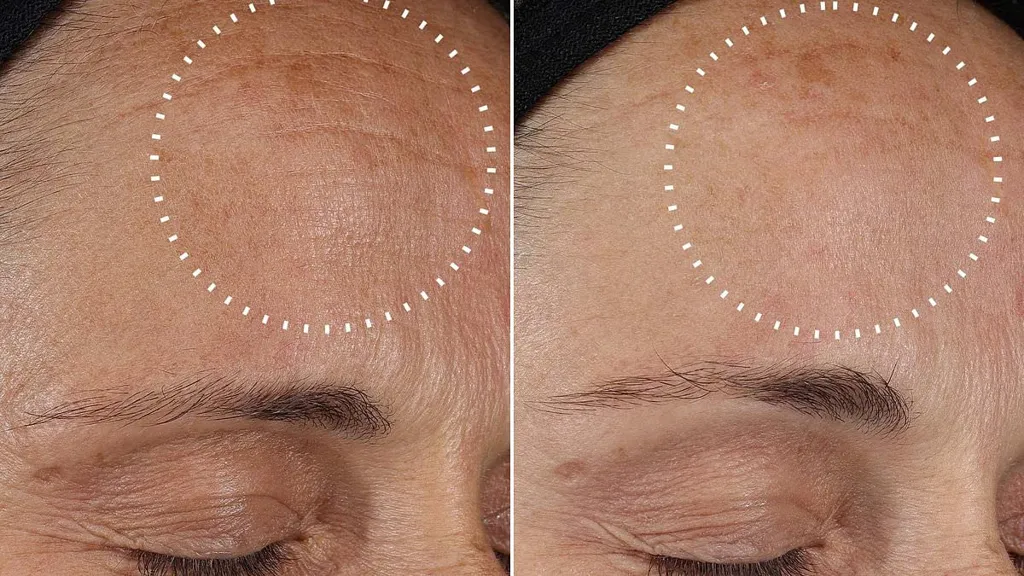 The cheap, non-surgical solution to your lines and brown marks