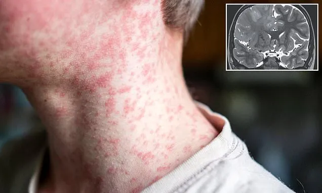 Terrifying measles side effect lurking in kids and killing years later