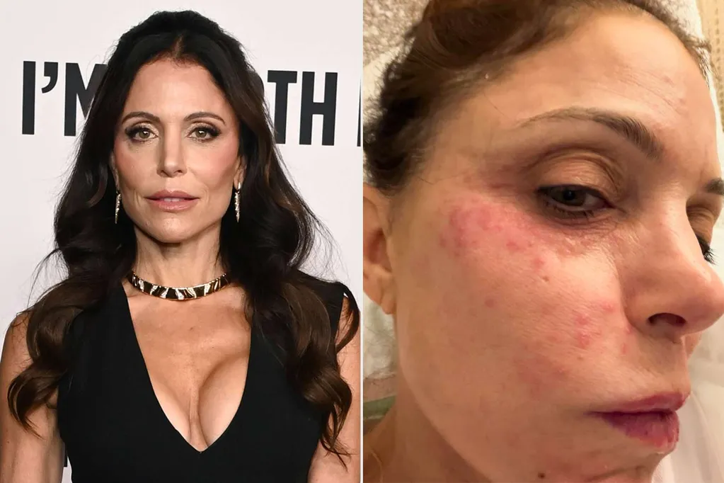 Bethenny Frankel Says She Will Never Use a Hotel Towel or Sheet Again After Bacterial Infection in St. Barths