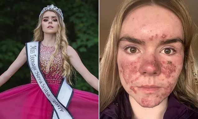 I was a pageant queen... then severe acne ruined my life