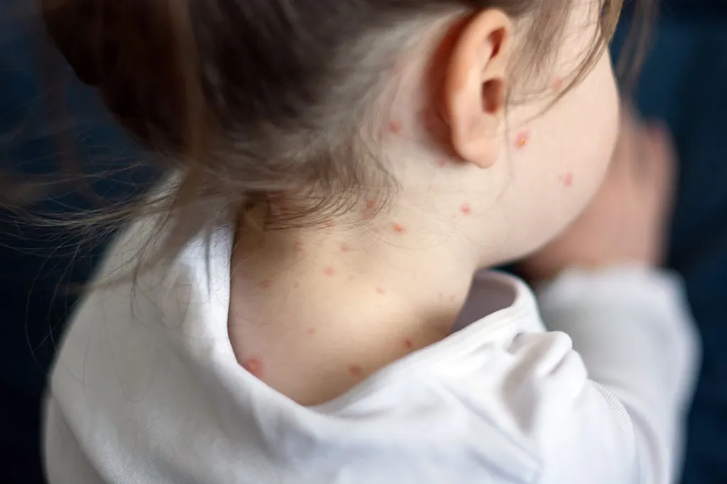 Measles Outbreak in South Carolina Doubles in One Week, Bringing the Total Number to 434 Confirmed Cases