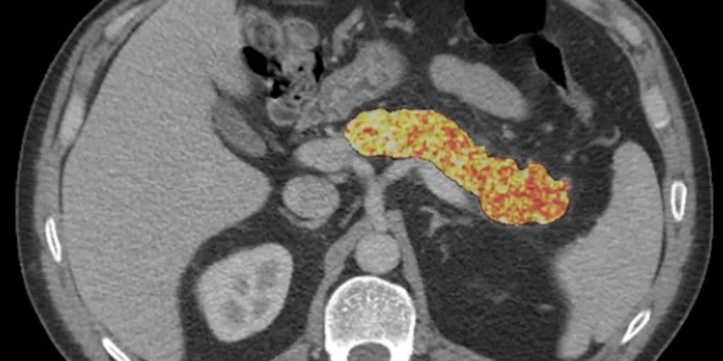 AI finds signs of pancreatic cancer before tumors develop