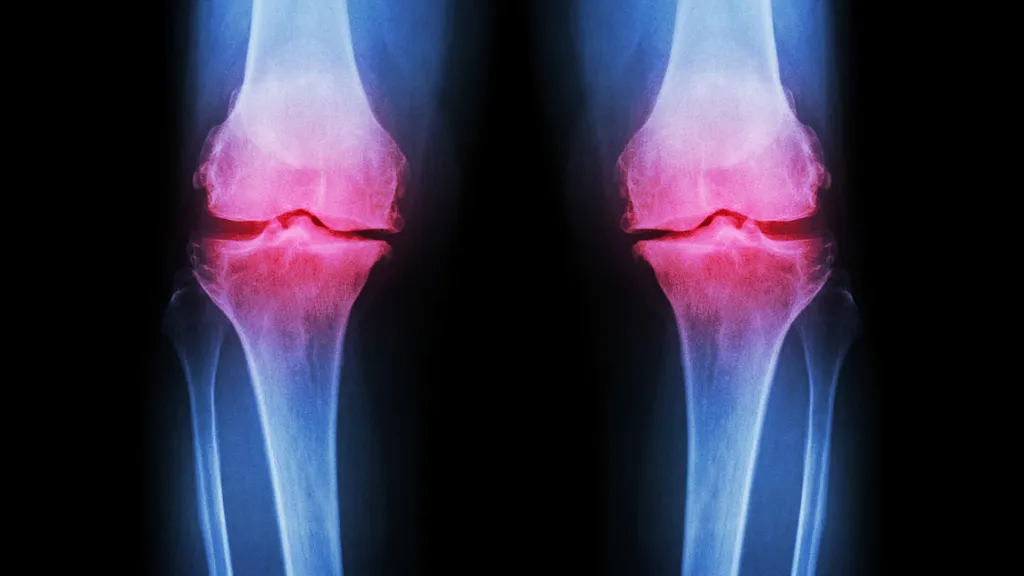 Why there's been a surge in younger people with osteoarthritis