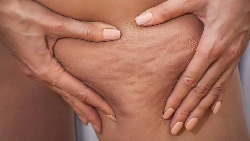 Experts reveal the difference between lipoedema and cellulite