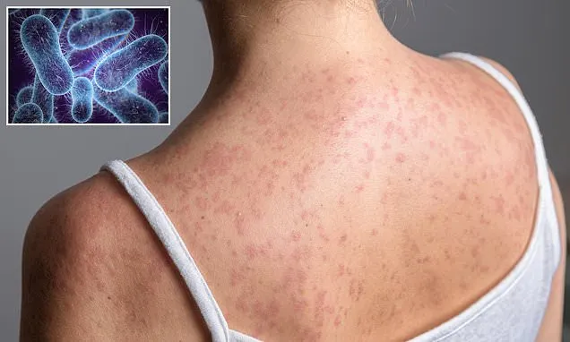 Deadly 'ancient fever' making comeback as it becomes drug-resistant