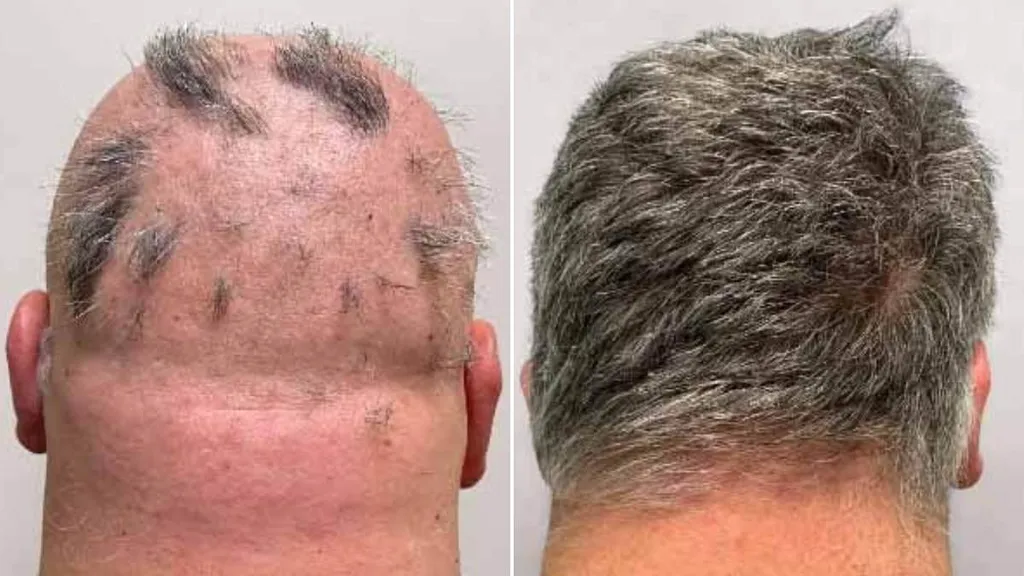 Health chiefs approve alopecia medication dubbed 'cure for baldness'