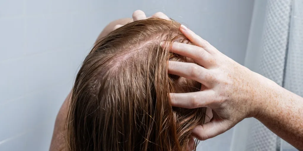 There's no way to prevent postpartum hair loss, but you can set the stage for future regrowth