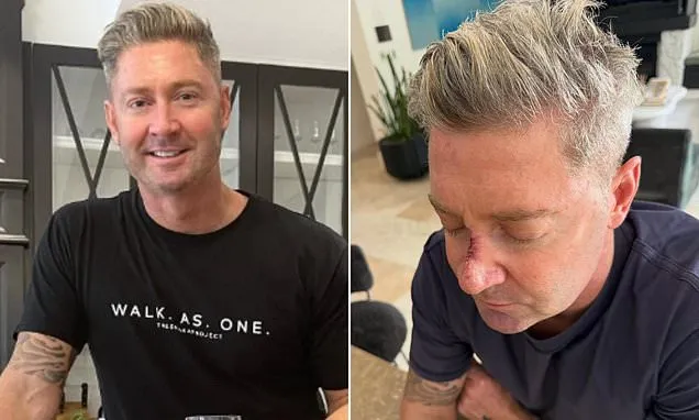 Michael Clarke reveals huge wound after having skin cancer treatment