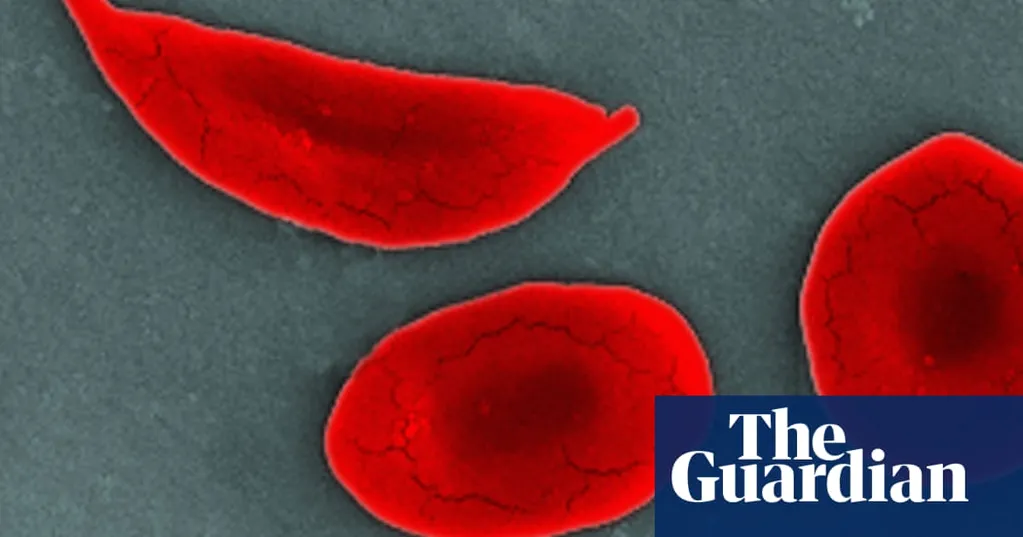 UK sickle cell patients 'get worse care than sufferers of similar disorders'