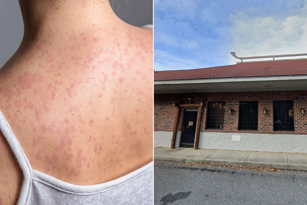 Health Officials Alert Diners to Possible Measles Exposure After Restaurant Visit in This State