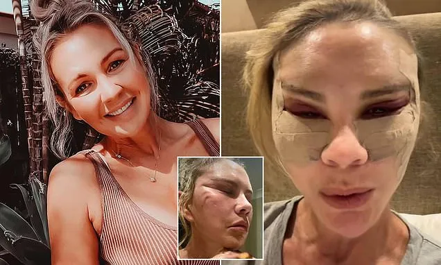 After my Turkey facelift, a certain type of woman was the most cruel