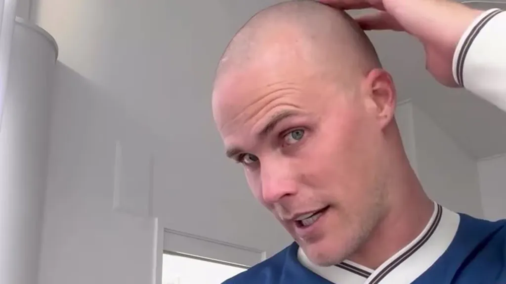 Jett Kenny, 31, reveals he's going bald and may get a hair transplant