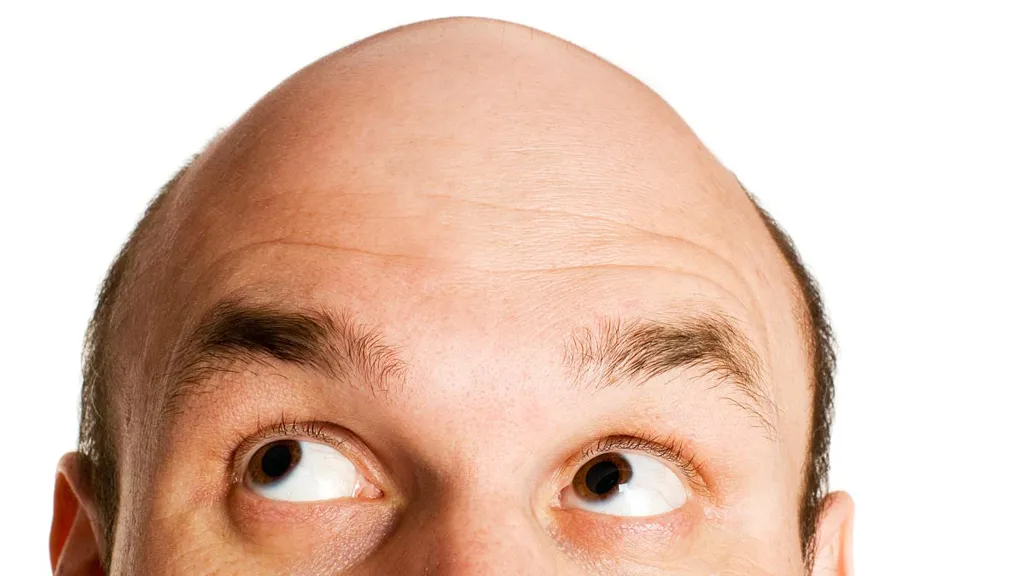 The physical trait that makes you SIX TIMES more likely to go bald