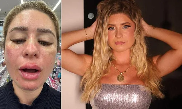 Influencer's Face ID can't recognise her after $2,000 worth of filler
